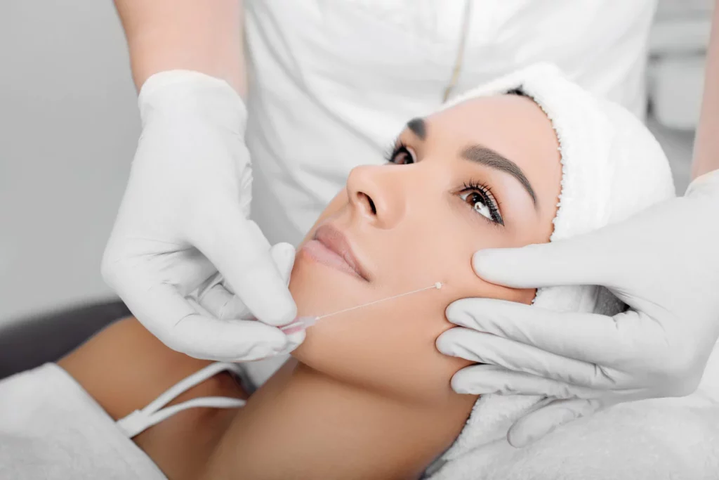 Face threads, also known as “thread lifts,” are a non-surgical procedure | Thrive Wellness in Cummings Hwy, Chattanooga, TN