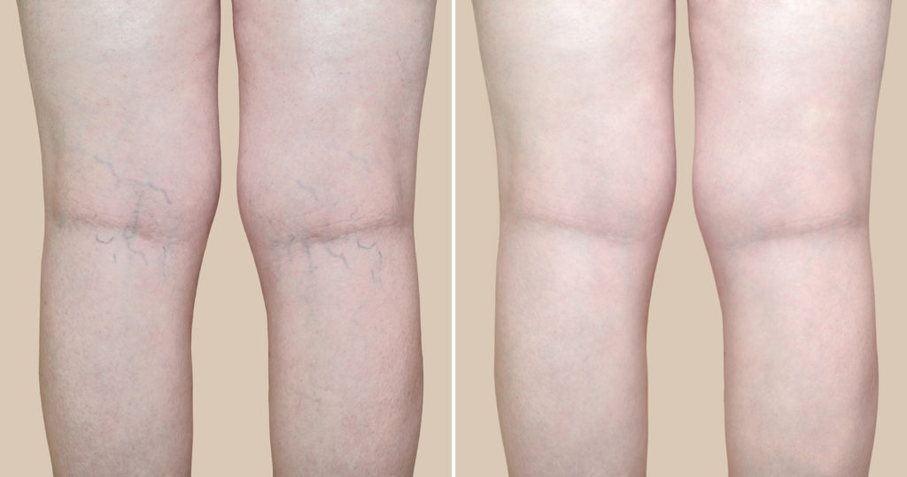 Legs of a woman with varicose veins and capillaries before and after Vein Removal | Thrive Wellness in Cummings Hwy, Chattanooga, TN