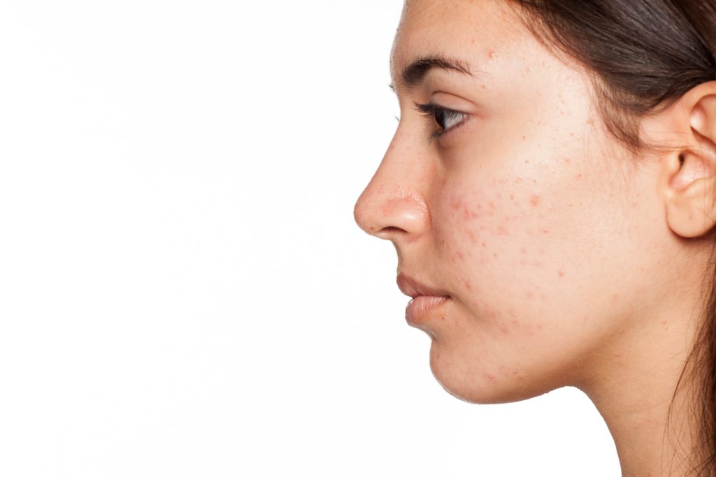 How does Aviclear Acne Treatment compare to other acne treatments