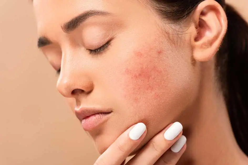 Aviclear Acne Treatment in Chattanooga, TN by Thrive Wellness