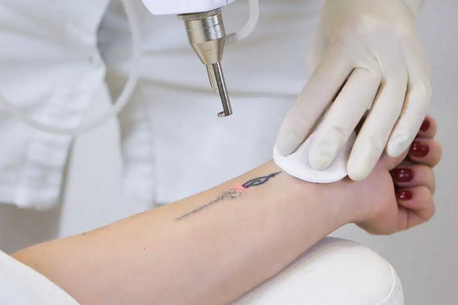 Laser Tattoo Removal in Chattanooga, TN by Thrive Wellness