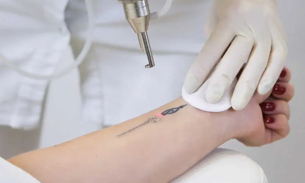 Laser Tattoo Removal in Chattanooga, TN by Thrive Wellness